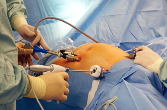 gynejkologicka laparoskopie